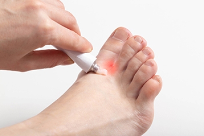 Athlete’s Foot Is a Common Fungal Infection