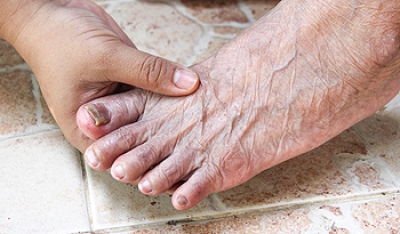 Toenail Fungus Is a Skin Disease That Hides Under the Nails